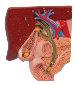 Model žlčového kameňa