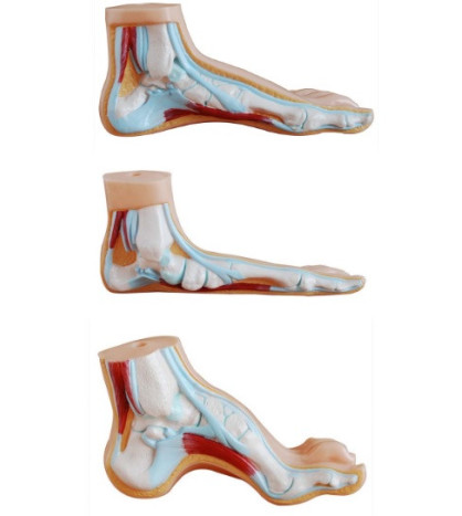 Model normálneho, plochého a vysoko klenutého chodidla - ekonomický model